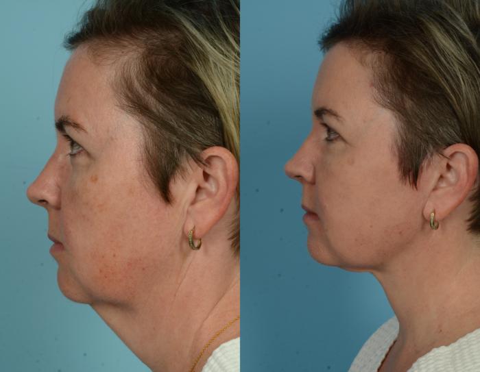 Before & After Deep Plane Facelift by Dr. Mustoe Case 1079 Left Side View in Chicago, IL