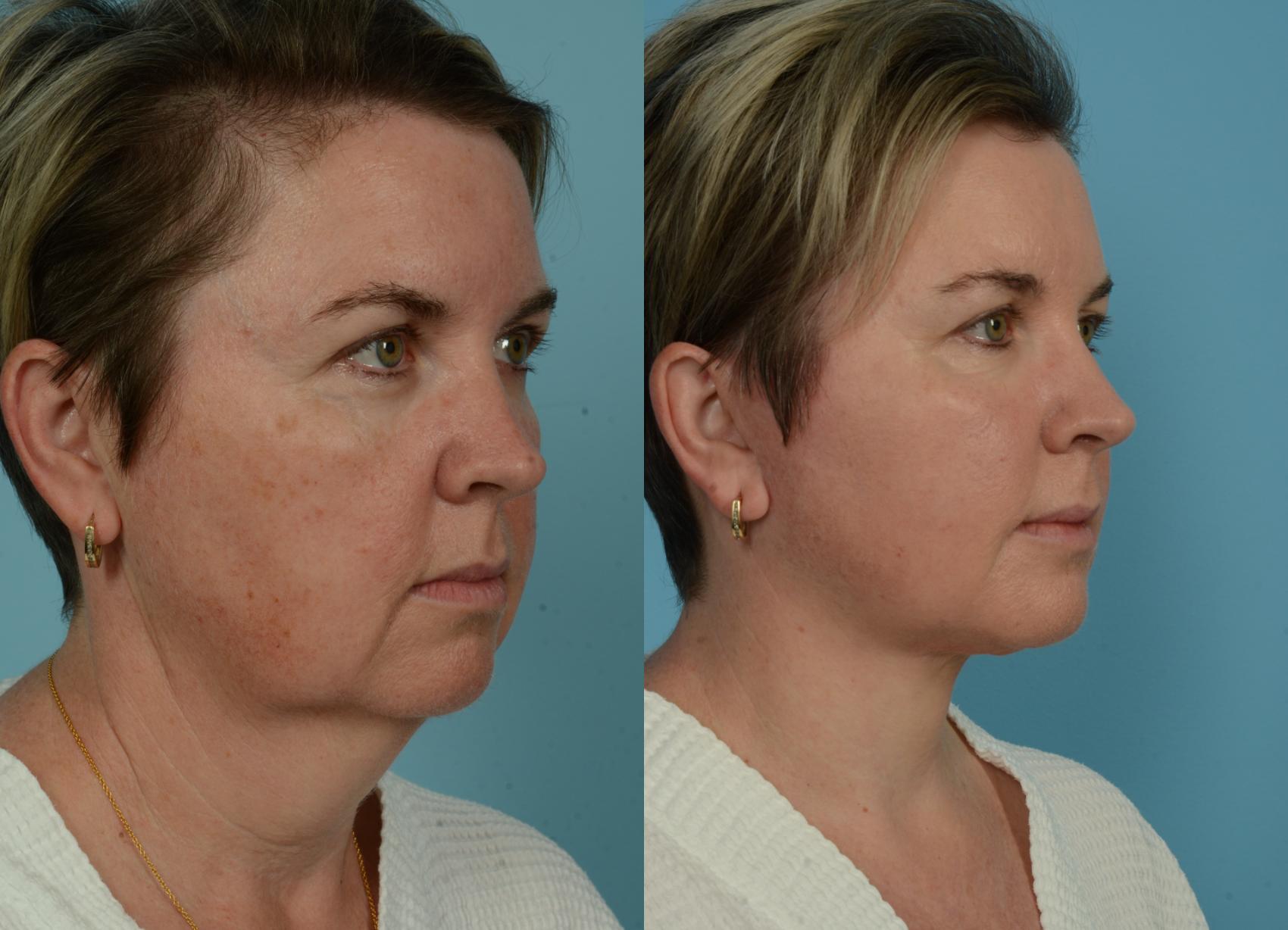 Before & After Neck Lift by Dr. Mustoe Case 1079 Right Oblique View in Chicago, IL