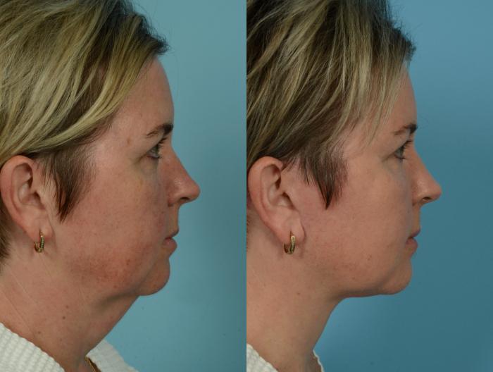 Before & After Deep Plane Facelift by Dr. Mustoe Case 1079 Right Side View in Chicago, IL