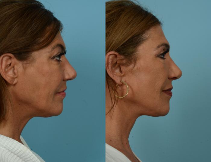 Before & After Deep Plane Facelift by Dr. Mustoe Case 1080 Right Side View in Chicago, IL