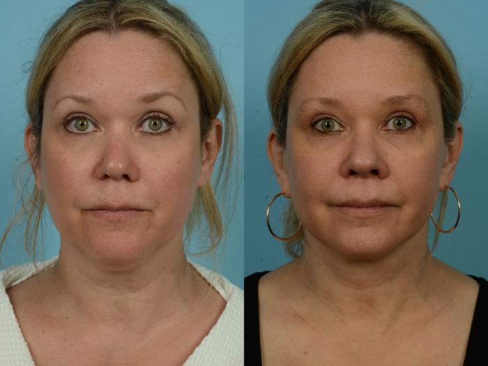 Before & After Deep Plane Facelift by Dr. Mustoe Case 1130 Front View in Chicago, IL