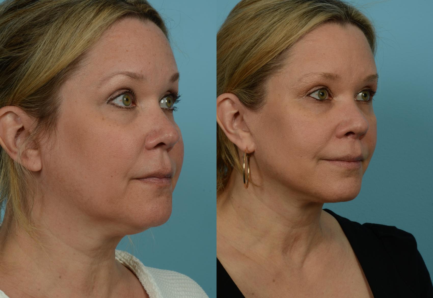 Before & After Deep Plane Facelift by Dr. Mustoe Case 1130 Right Oblique View in Chicago, IL