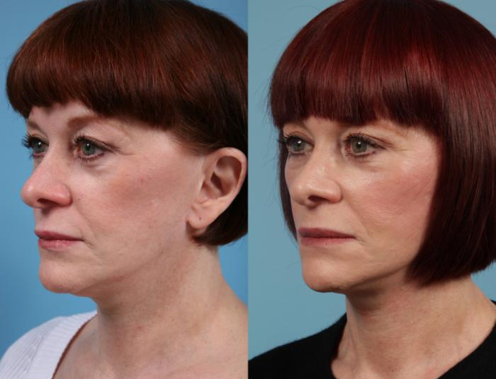 Before & After Deep Plane Facelift by Dr. Mustoe Case 156 Left Oblique View in Chicago, IL