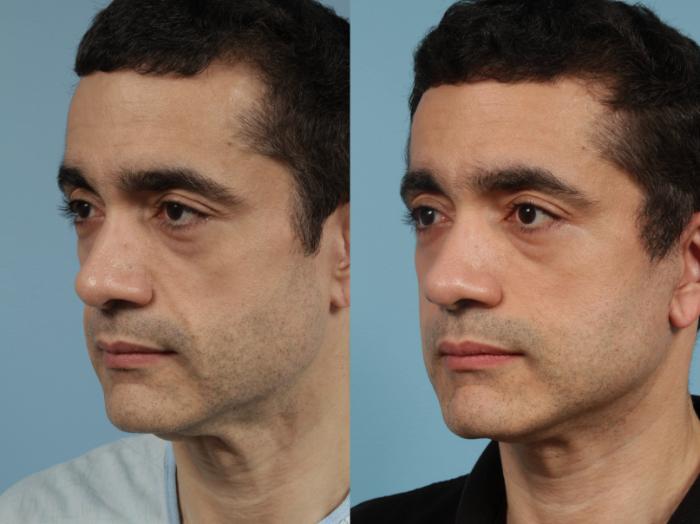 Before & After Deep Plane Facelift by Dr. Mustoe Case 164 Left Oblique View in Chicago, IL