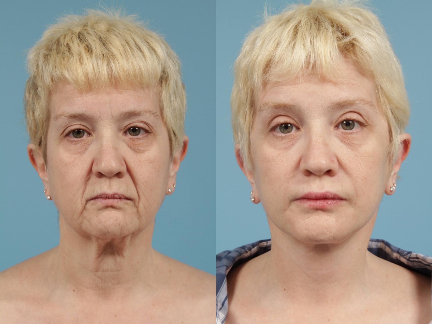 Before & After Deep Plane Facelift by Dr. Mustoe Case 170 Front View in Chicago, IL