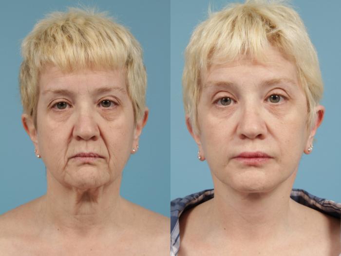 Before & After Deep Plane Facelift by Dr. Mustoe Case 170 Front View in Chicago, IL