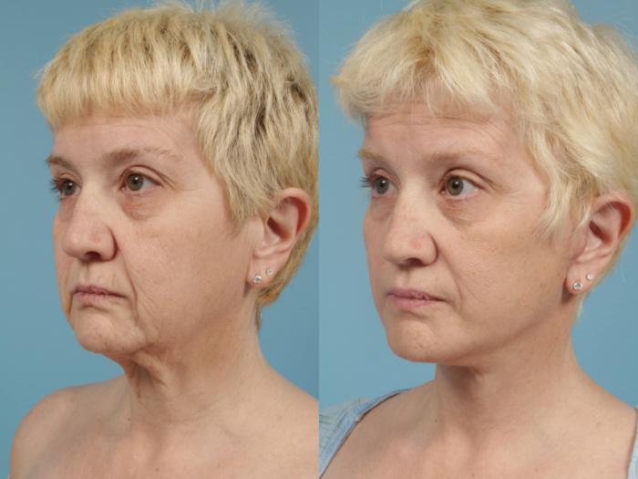 Before & After Deep Plane Facelift by Dr. Mustoe Case 170 Left Oblique View in Chicago, IL
