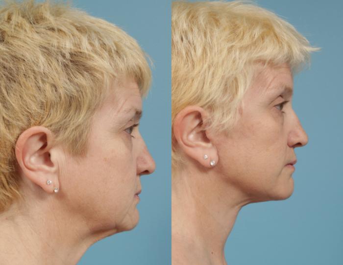 Before & After Deep Plane Facelift by Dr. Mustoe Case 170 Right Side View in Chicago, IL