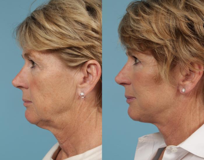 Before & After Deep Plane Facelift by Dr. Mustoe Case 216 Left Side View in Chicago, IL