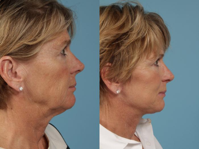 Before & After Deep Plane Facelift by Dr. Mustoe Case 216 View #3 View in Chicago, IL