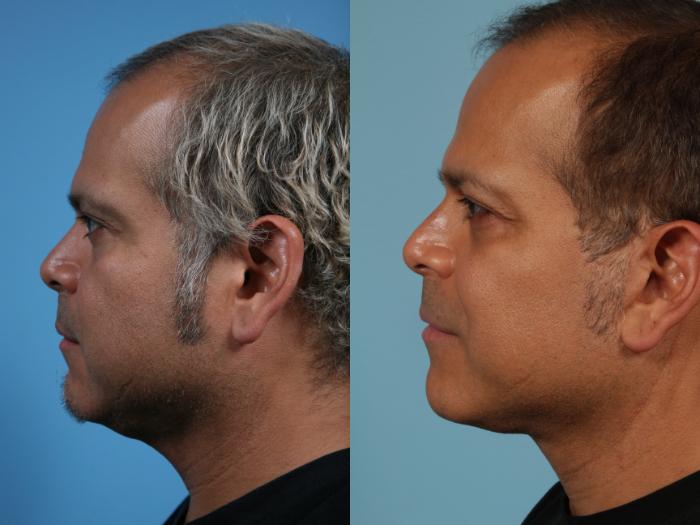 Before & After Deep Plane Facelift by Dr. Mustoe Case 229 View #2 View in Chicago, IL