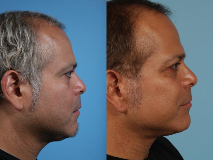 Before & After Deep Plane Facelift by Dr. Mustoe Case 229 View #3 View in Chicago, IL