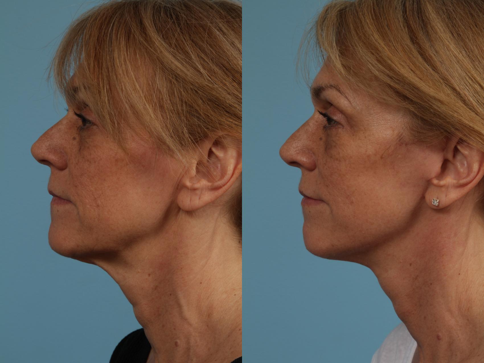 Before & After Neck Lift by Dr. Mustoe Case 280 View #2 View in Chicago, IL