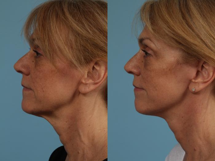 Before & After Deep Plane Facelift by Dr. Mustoe Case 280 View #2 View in Chicago, IL