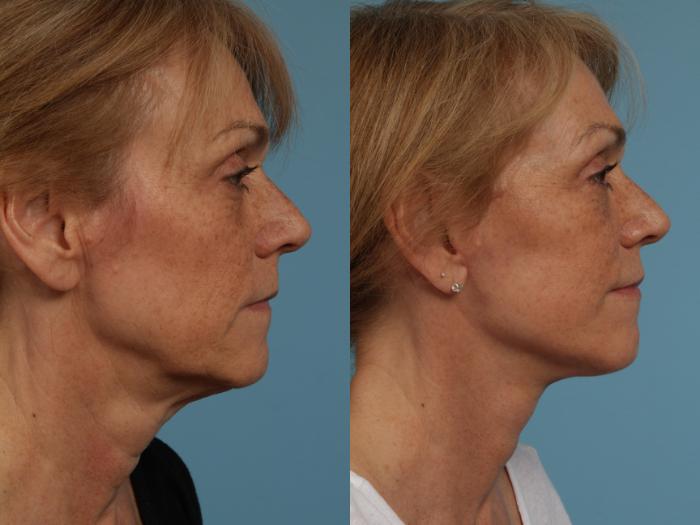 Before & After Deep Plane Facelift by Dr. Mustoe Case 280 View #3 View in Chicago, IL