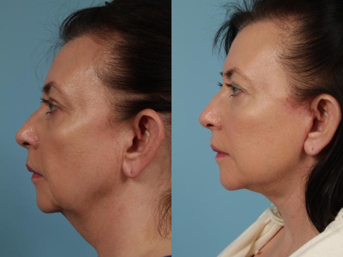 Before & After Deep Plane Facelift by Dr. Mustoe Case 329 View #2 View in Chicago, IL
