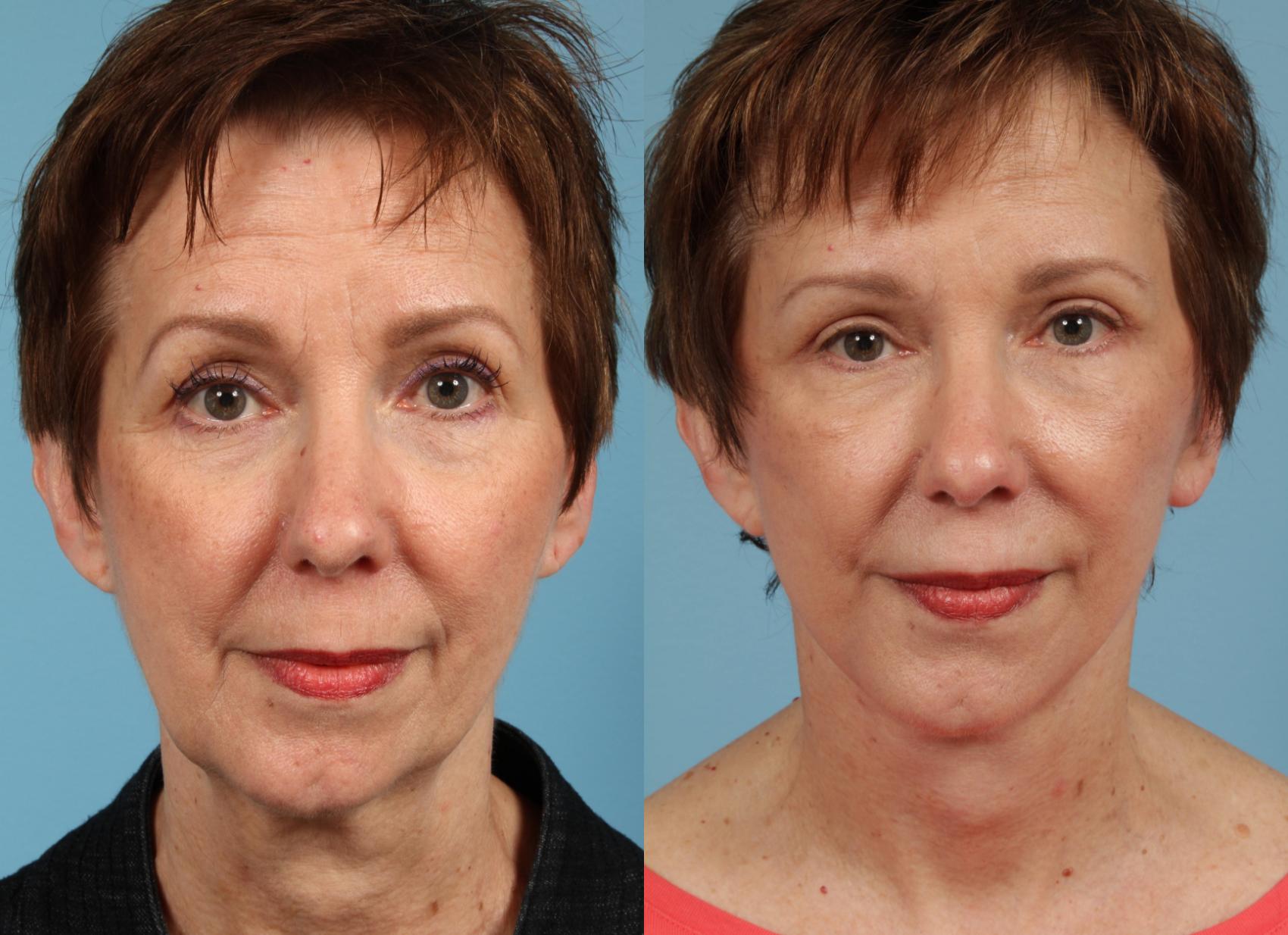 Before & After Deep Plane Facelift by Dr. Mustoe Case 38 Front View in Chicago, IL