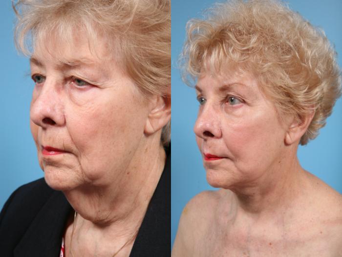 Before & After Deep Plane Facelift by Dr. Mustoe Case 69 View #1 View in Chicago, IL
