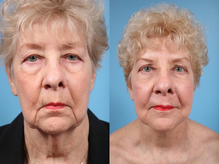 Before & After Deep Plane Facelift by Dr. Mustoe Case 69 View #2 View in Chicago, IL