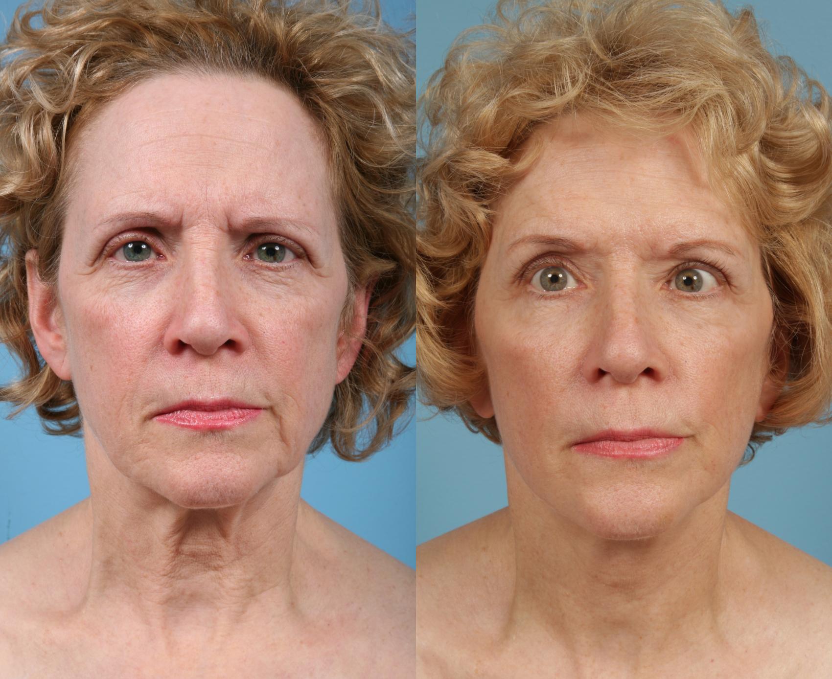 Before & After Neck Lift by Dr. Mustoe Case 76 Front View in Chicago, IL