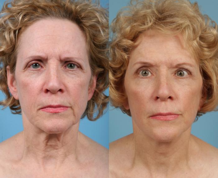 Before & After Deep Plane Facelift by Dr. Mustoe Case 76 Front View in Chicago, IL