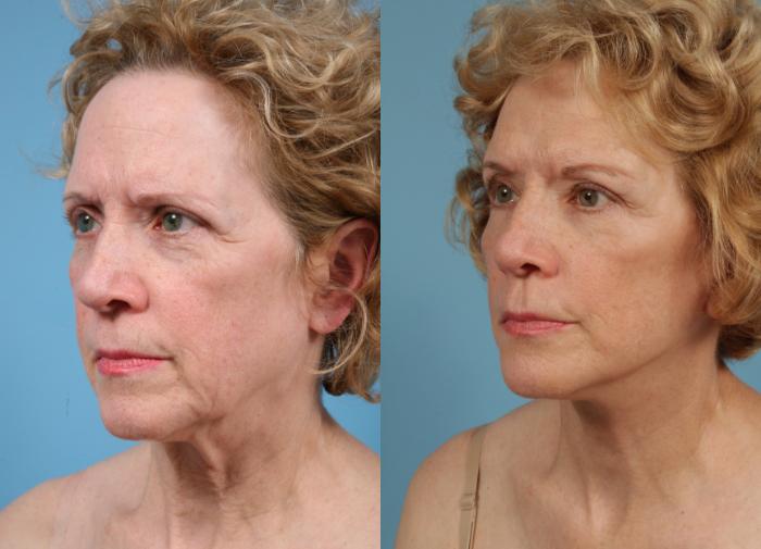 Before & After Deep Plane Facelift by Dr. Mustoe Case 76 Left Oblique View in Chicago, IL