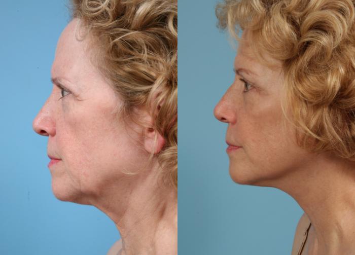 Before & After Deep Plane Facelift by Dr. Mustoe Case 76 Left Side View in Chicago, IL