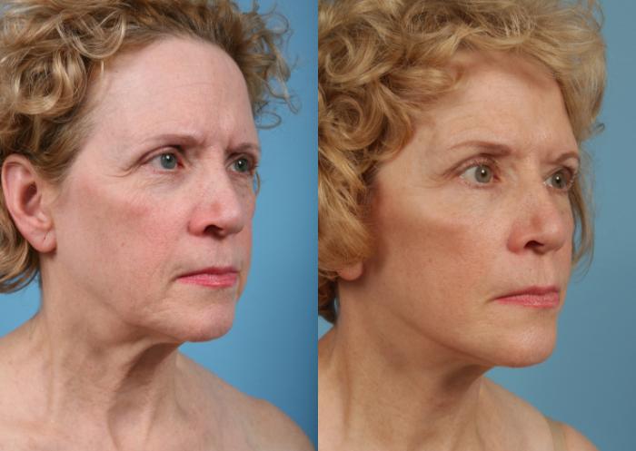 Before & After Deep Plane Facelift by Dr. Mustoe Case 76 Right Oblique View in Chicago, IL