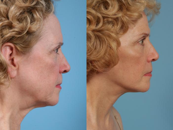 Before & After Deep Plane Facelift by Dr. Mustoe Case 76 Right Side View in Chicago, IL