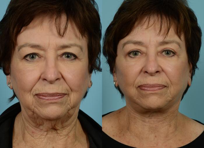Before & After Deep Plane Facelift by Dr. Mustoe Case 770 Front View in Chicago, IL