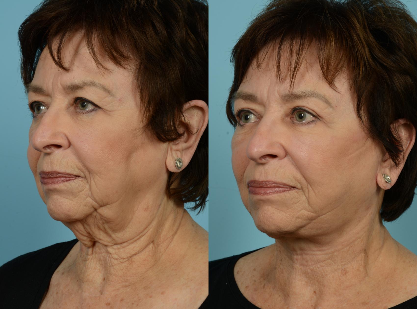 Before & After Neck Lift by Dr. Mustoe Case 770 Left Oblique View in Chicago, IL