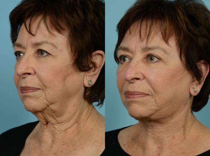 Before & After Deep Plane Facelift by Dr. Mustoe Case 770 Left Oblique View in Chicago, IL