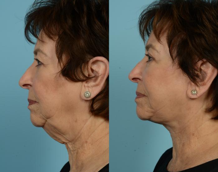 Before & After Deep Plane Facelift by Dr. Mustoe Case 770 Left Side View in Chicago, IL