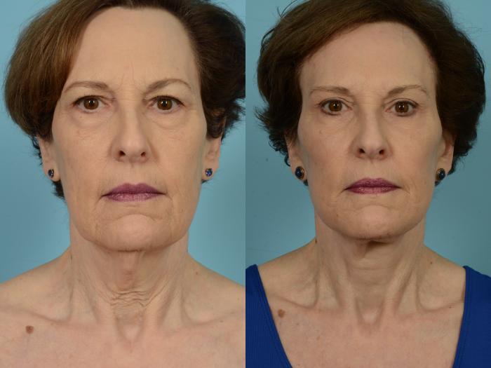 Before & After Deep Plane Facelift by Dr. Mustoe Case 796 Front View in Chicago, IL