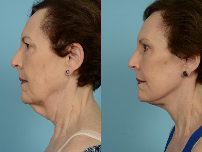Before & After Deep Plane Facelift by Dr. Mustoe Case 796 Left Side View in Chicago, IL