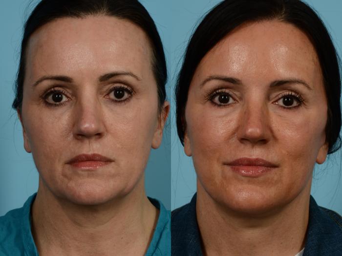 Before & After Deep Plane Facelift by Dr. Mustoe Case 841 Front View in Chicago, IL