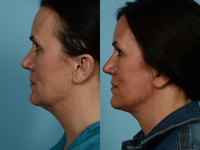 Before & After Deep Plane Facelift by Dr. Mustoe Case 841 Left Side View in Chicago, IL