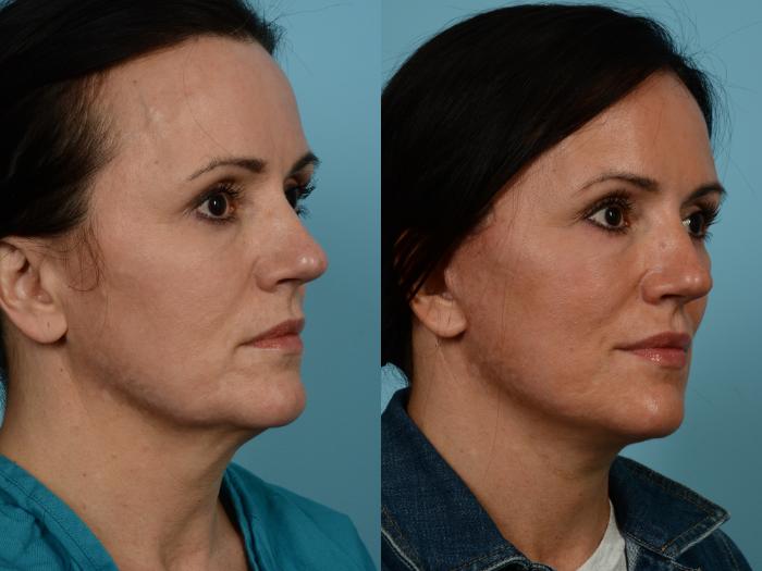 Before & After Deep Plane Facelift by Dr. Mustoe Case 841 Right Oblique View in Chicago, IL