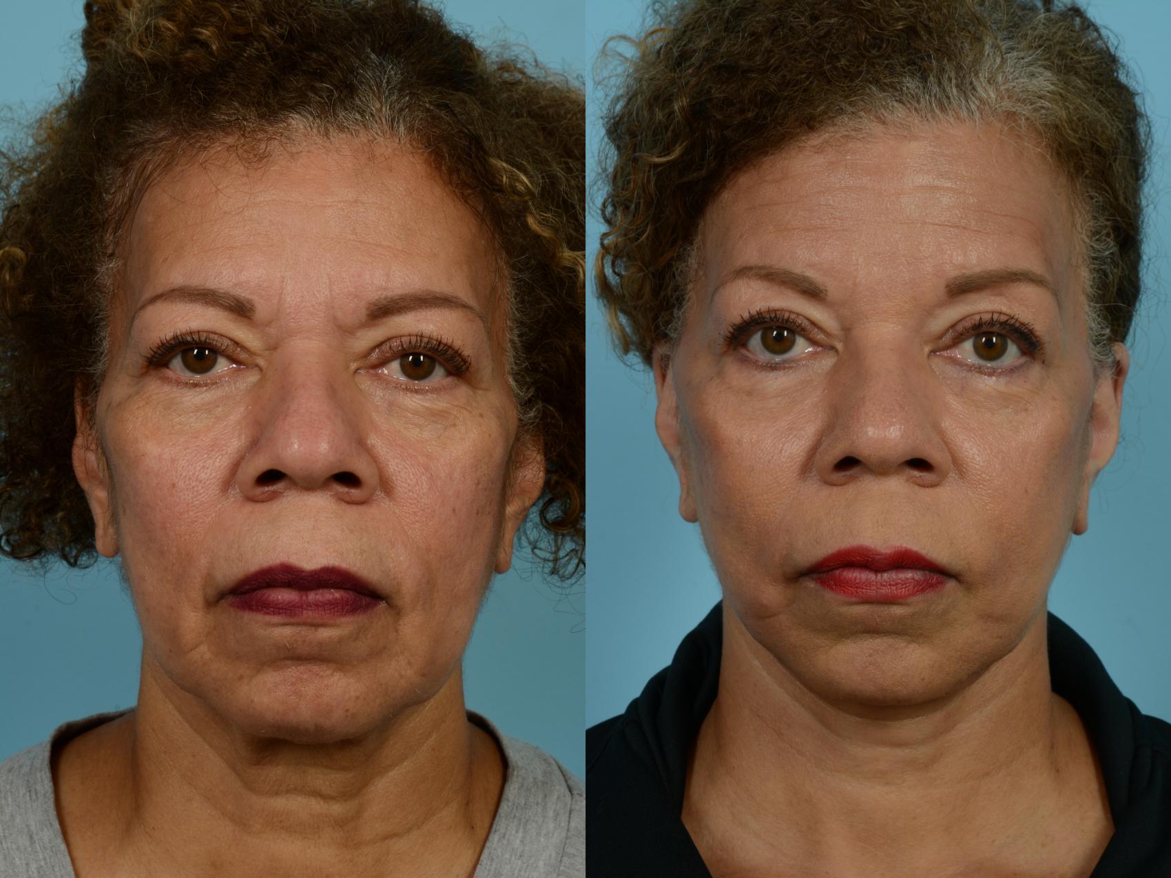 Before & After Deep Plane Facelift by Dr. Mustoe Case 926 Front View in Chicago, IL