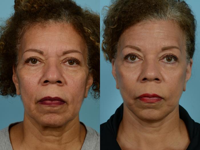 Before & After Deep Plane Facelift by Dr. Mustoe Case 926 Front View in Chicago, IL