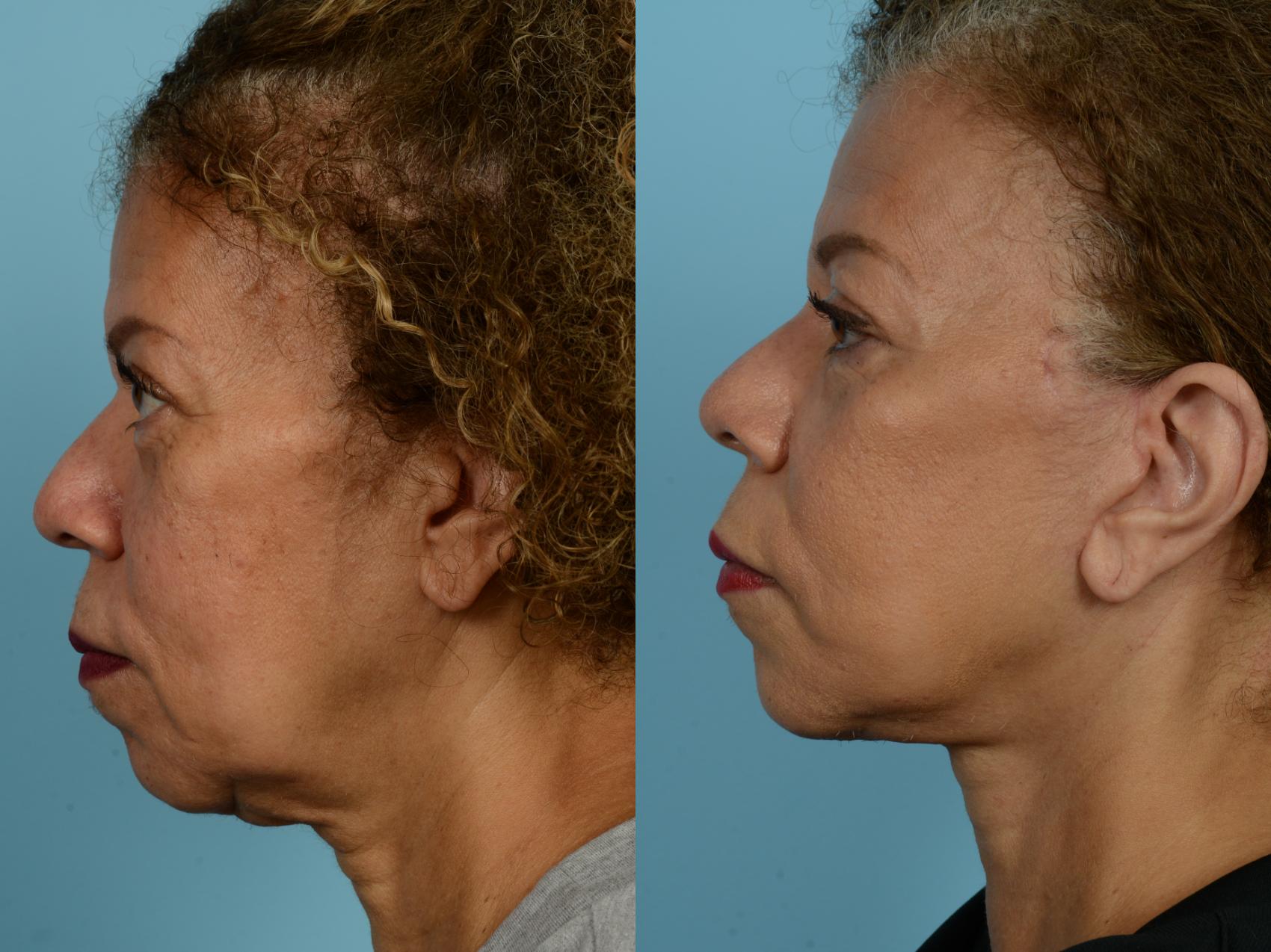 Before & After Deep Plane Facelift by Dr. Mustoe Case 926 Left Side View in Chicago, IL