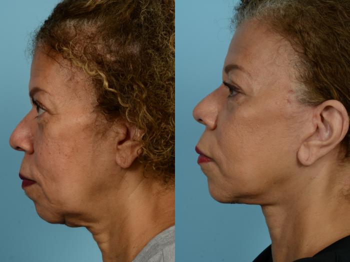 Before & After Deep Plane Facelift by Dr. Mustoe Case 926 Left Side View in Chicago, IL
