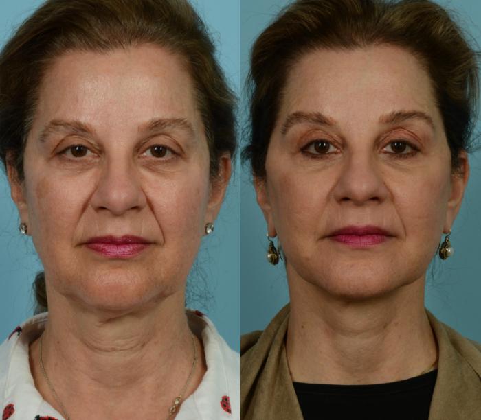 Before & After Deep Plane Facelift by Dr. Mustoe Case 930 Front View in Chicago, IL