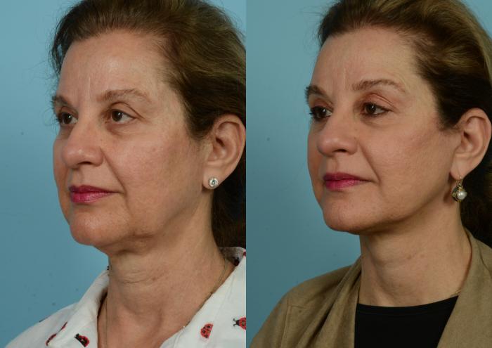 Before & After Deep Plane Facelift by Dr. Mustoe Case 930 Left Oblique View in Chicago, IL