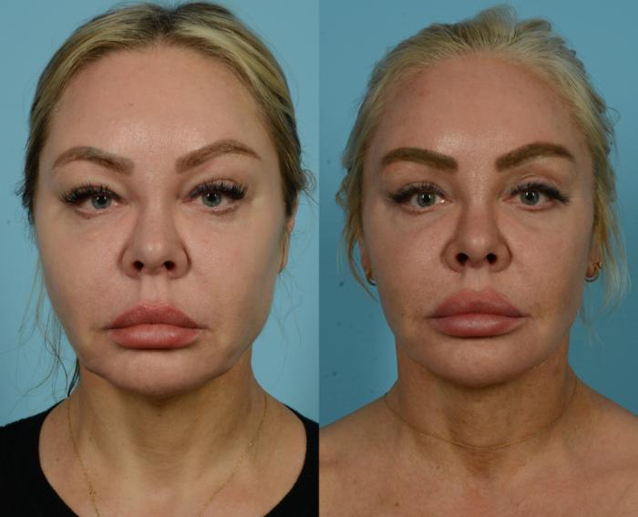 Before & After Deep Plane Facelift by Dr. Mustoe Case 933 Front View in Chicago, IL