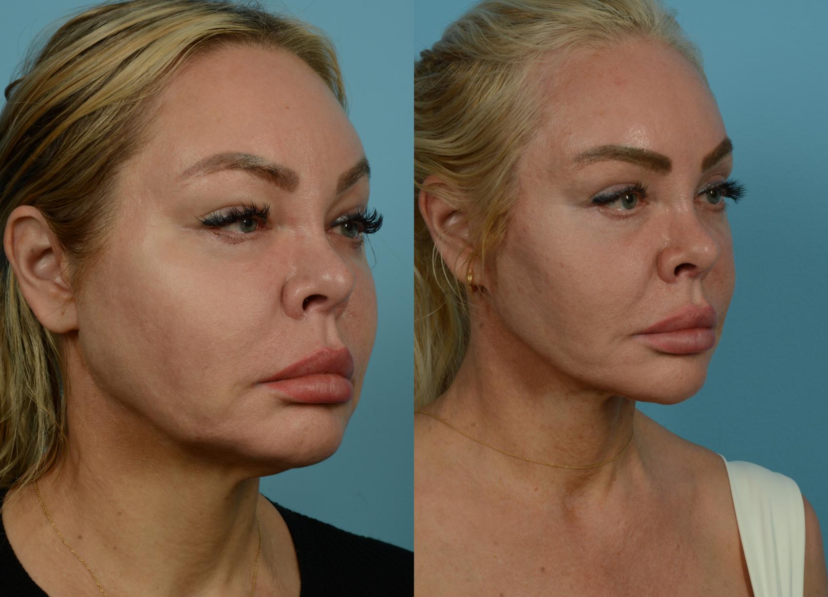 Before & After Deep Plane Facelift by Dr. Mustoe Case 933 Right Oblique View in Chicago, IL
