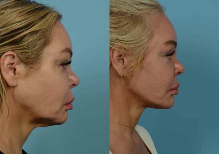 Before & After Deep Plane Facelift by Dr. Mustoe Case 933 Right Side View in Chicago, IL