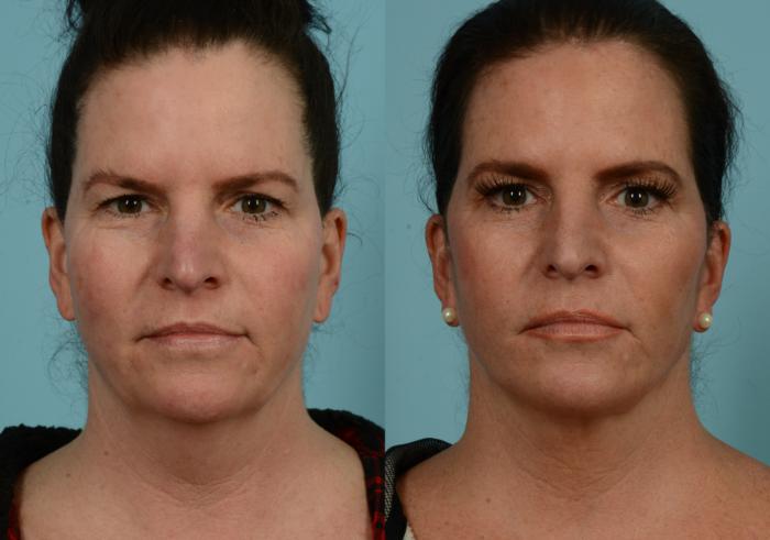 Before & After Deep Plane Facelift by Dr. Mustoe Case 937 Front View in Chicago, IL