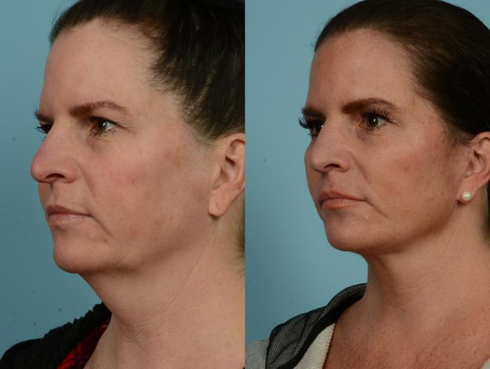Before & After Deep Plane Facelift by Dr. Mustoe Case 937 Left Oblique View in Chicago, IL