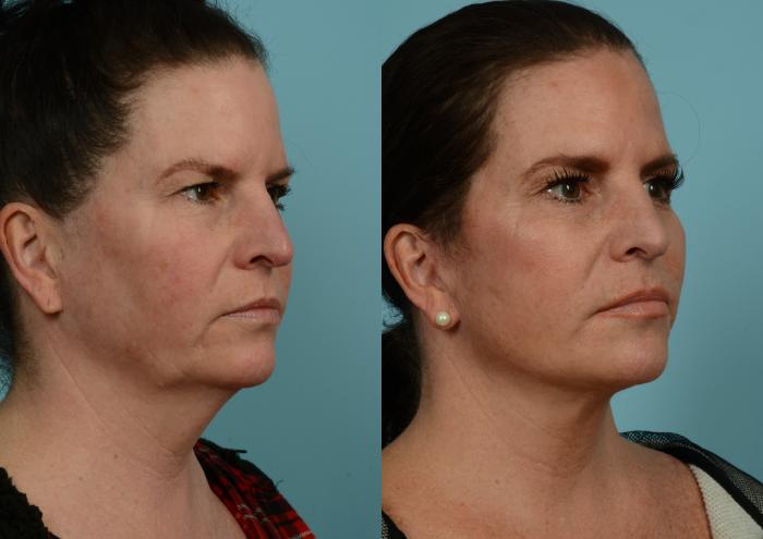 Before & After Deep Plane Facelift by Dr. Mustoe Case 937 Right Oblique View in Chicago, IL